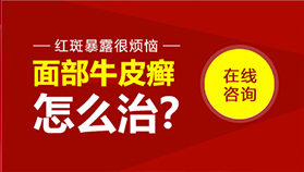 面部牛皮癣怎么治？